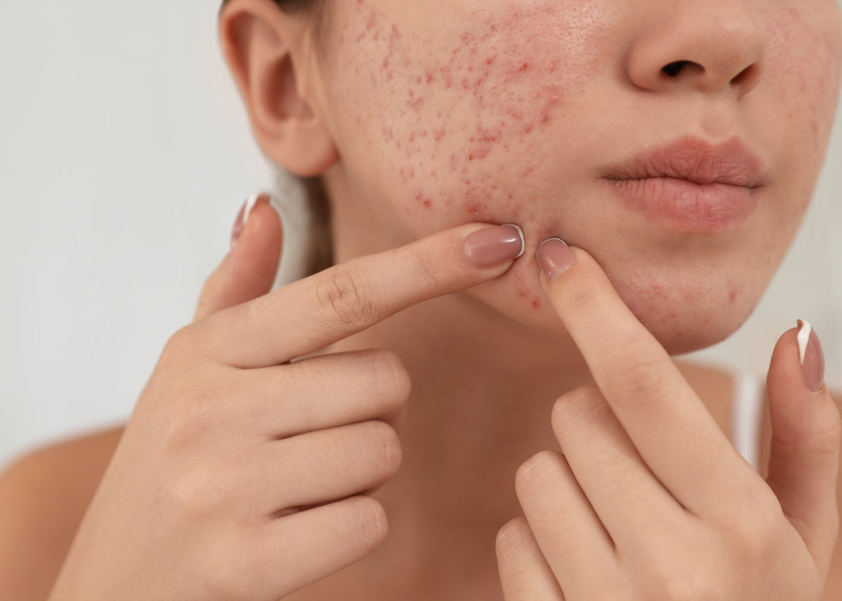 image of female with acne on her face